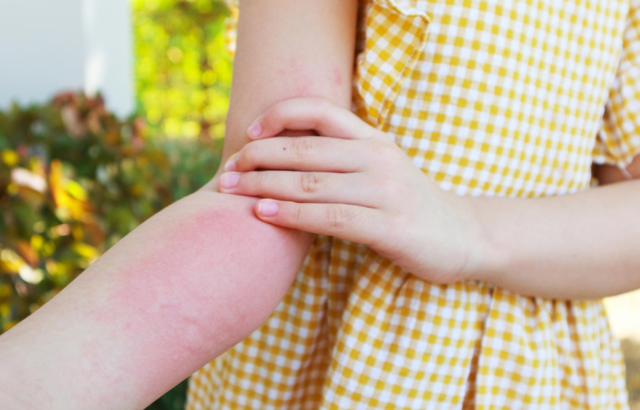 Средства от укусов насекомых в аптеке. Как помочь покупателю?